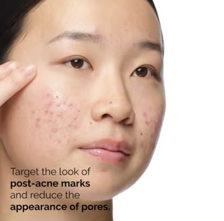Aloe 2% + NAG 2% Solution for Post-Acne Marks