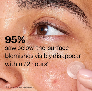 Deep Blemish Microdarts